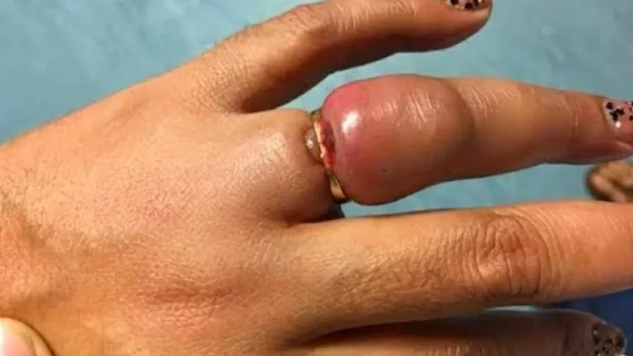 how to remove ring stuck in finger
